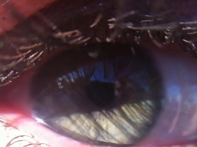 Eyelash Impaction: Causes, Recognition, and Remedy