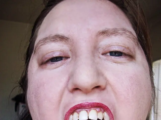 Urfi Javed Removes Lip Fillers, Posts Video of Swollen Face on Instagram