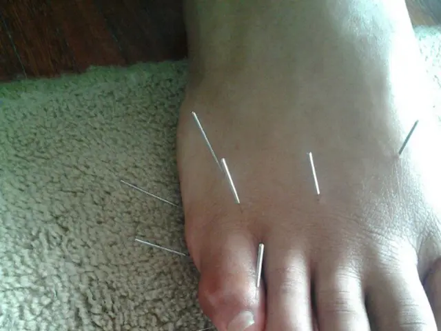 Surgical intervention using endovascular stent grafting to treat the erosion of the superior...