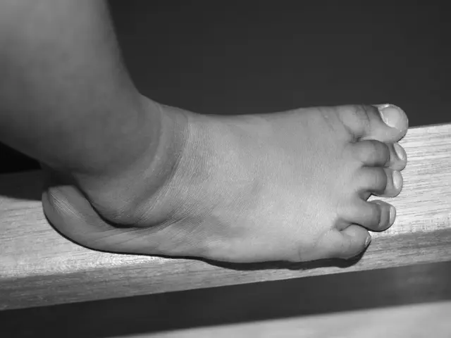 Deep Vein Thrombosis in the Femoral Region: Causes, Signs, and Frequently Asked Questions